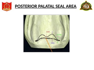 POSTERIOR PALATAL SEAL AREA
 