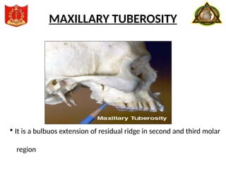 • It is a bulbuos extension of residual ridge in second and third molar
region
MAXILLARY TUBEROSITY
 