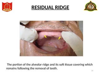 23
The portion of the alveolar ridge and its soft tissue covering which
remains following the removal of teeth.
RESIDUAL RIDGE
 