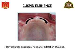 · Bony elevation on residual ridge after extraction of canine.
CUSPID EMINENCE
 