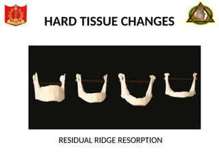HARD TISSUE CHANGES
RESIDUAL RIDGE RESORPTION
 