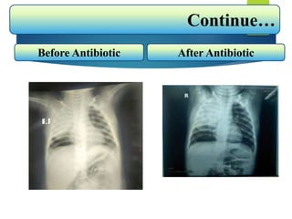 Continue…
Before Antibiotic After Antibiotic
 
