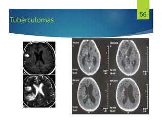 Tuberculomas
56
 