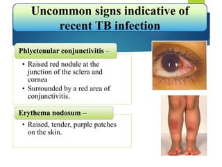 • Raised red nodule at the
junction of the sclera and
cornea
• Surrounded by a red area of
conjunctivitis.
Phlyctenular conjunctivitis –
• Raised, tender, purple patches
on the skin.
Erythema nodosum –
Uncommon signs indicative of
recent TB infection
 
