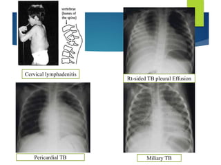 Cervical lymphadenitis
Rt-sided TB pleural Effusion
Pericardial TB Miliary TB
 