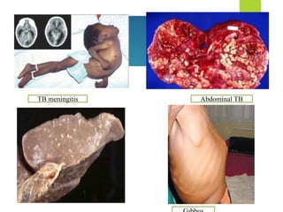 TB meningitis Abdominal TB
 
