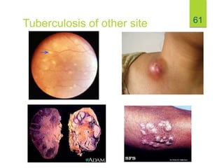 61
Tuberculosis of other site
 