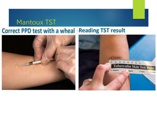 Mantoux TST
 