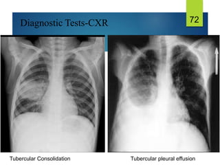 Tubercular Consolidation
Diagnostic Tests-CXR 72
Tubercular pleural effusion
 