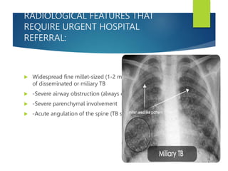 RADIOLOGICAL FEATURES THAT
REQUIRE URGENT HOSPITAL
REFERRAL:
 Widespread fine millet-sized (1-2 mm) lesions indicative
of disseminated or miliary TB
 -Severe airway obstruction (always evaluate the airways)
 -Severe parenchymal involvement
 -Acute angulation of the spine (TB spine, gibbus)
 