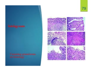 histology exam
Caseating granulomas
on histology
79
 