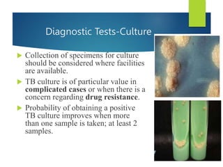 Diagnostic Tests-Culture
 Collection of specimens for culture
should be considered where facilities
are available.
 TB culture is of particular value in
complicated cases or when there is a
concern regarding drug resistance.
 Probability of obtaining a positive
TB culture improves when more
than one sample is taken; at least 2
samples.
 