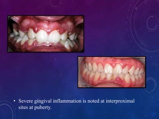• Severe gingival inflammation is noted at interproximal
sites at puberty.
 