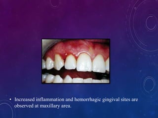 • Increased inflammation and hemorrhagic gingival sites are
observed at maxillary area.
 