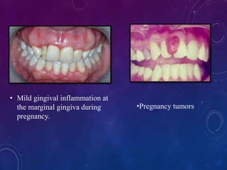 • Mild gingival inflammation at
the marginal gingiva during
pregnancy.
•Pregnancy tumors
 