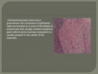 Histopathologically tuberculous 
granulomas are composed of epithelioid 
cells surrounded by a zone of fibroblasts & 
lymphocyte that usually contains langhans 
giant cells & some necrosis (caseation) is 
usually present in the center of the 
tubercles 
 