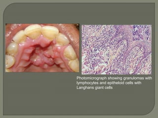 Photomicrograph showing granulomas with 
lymphocytes and epitheloid cells with 
Langhans giant cells 
 