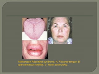 Melkersson-Rosenthal syndrome. A, Fissured tongue; B, 
granulomatous cheilitis; C, facial nerve palsy. 
 
