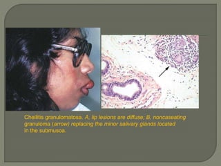 Cheilitis granulomatosa. A, lip lesions are diffuse; B, noncaseating 
granuloma (arrow) replacing the minor salivary glands located 
in the submusoa. 
 