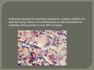  Antibodies directed to neutrophil cytoplasmic antigens (ANCA) are 
detected using indirect immunofluorescence with neutrophils as 
substrate, being positive in over 90% of cases. 
 