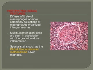 HISTOPATHOLOGICAL 
FEATURES: 
 Diffuse infiltrate of 
macrophages or more 
commonly collections of 
macrophages organized 
into granulomas. 
 Multinucleated giant cells 
are seen in association 
with the granulomatous 
inflammation. 
 Special stains such as the 
PAS & Grocott-Gomari 
methenamine silver 
methods. 
 