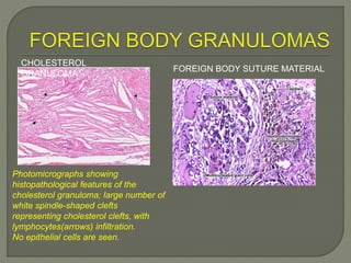 CHOLESTEROL 
GRANULOMA 
Photomicrographs showing 
histopathological features of the 
cholesterol granuloma; large number of 
white spindle-shaped clefts 
representing cholesterol clefts, with 
lymphocytes(arrows) infiltration. 
No epithelial cells are seen. 
FOREIGN BODY SUTURE MATERIAL 
 