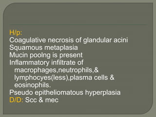 H/p: 
Coagulative necrosis of glandular acini 
Squamous metaplasia 
Mucin poolng is present 
Inflammatory infiltrate of 
macrophages,neutrophils,& 
lymphocyes(less),plasma cells & 
eosinophils. 
Pseudo epitheliomatous hyperplasia 
D/D: Scc & mec 
 