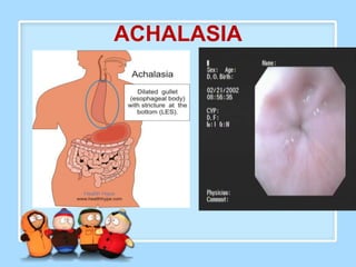 ACHALASIA
 