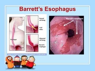 Barrett’s Esophagus
 