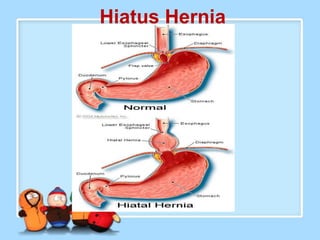 Hiatus Hernia
 