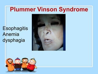 Plummer Vinson Syndrome


Esophagitis
Anemia
dysphagia
 