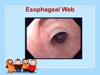 Esophageal Web
 