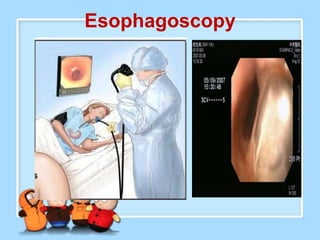 Esophagoscopy
 