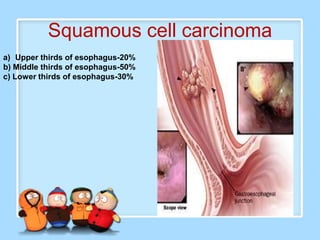Squamous cell carcinoma
a) Upper thirds of esophagus-20%
b) Middle thirds of esophagus-50%
c) Lower thirds of esophagus-30%
 