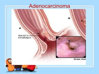 Adenocarcinoma
 