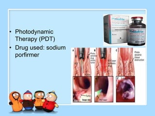• Photodynamic
  Therapy (PDT)
• Drug used: sodium
  porfirmer
 