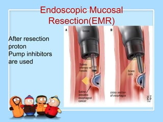 Endoscopic Mucosal
           Resection(EMR)
After resection
proton
Pump inhibitors
are used
 