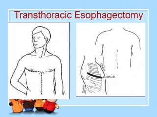 Transthoracic Esophagectomy
 