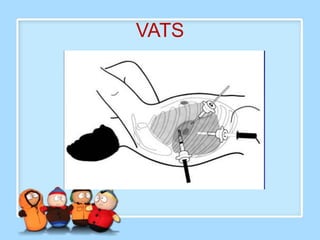 VATS
 