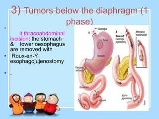 3) Tumors below the diaphragm (1
                           phase)
•
      lt thracoabdominal
  incision: the stomach
  & lower oesophagus
  are removed with
• Roux-en-Y
  esophagojujenostomy

• .
 