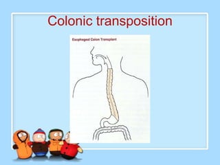 Colonic transposition
 