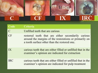 Caries Code R1 Indices for dental caries | PPT