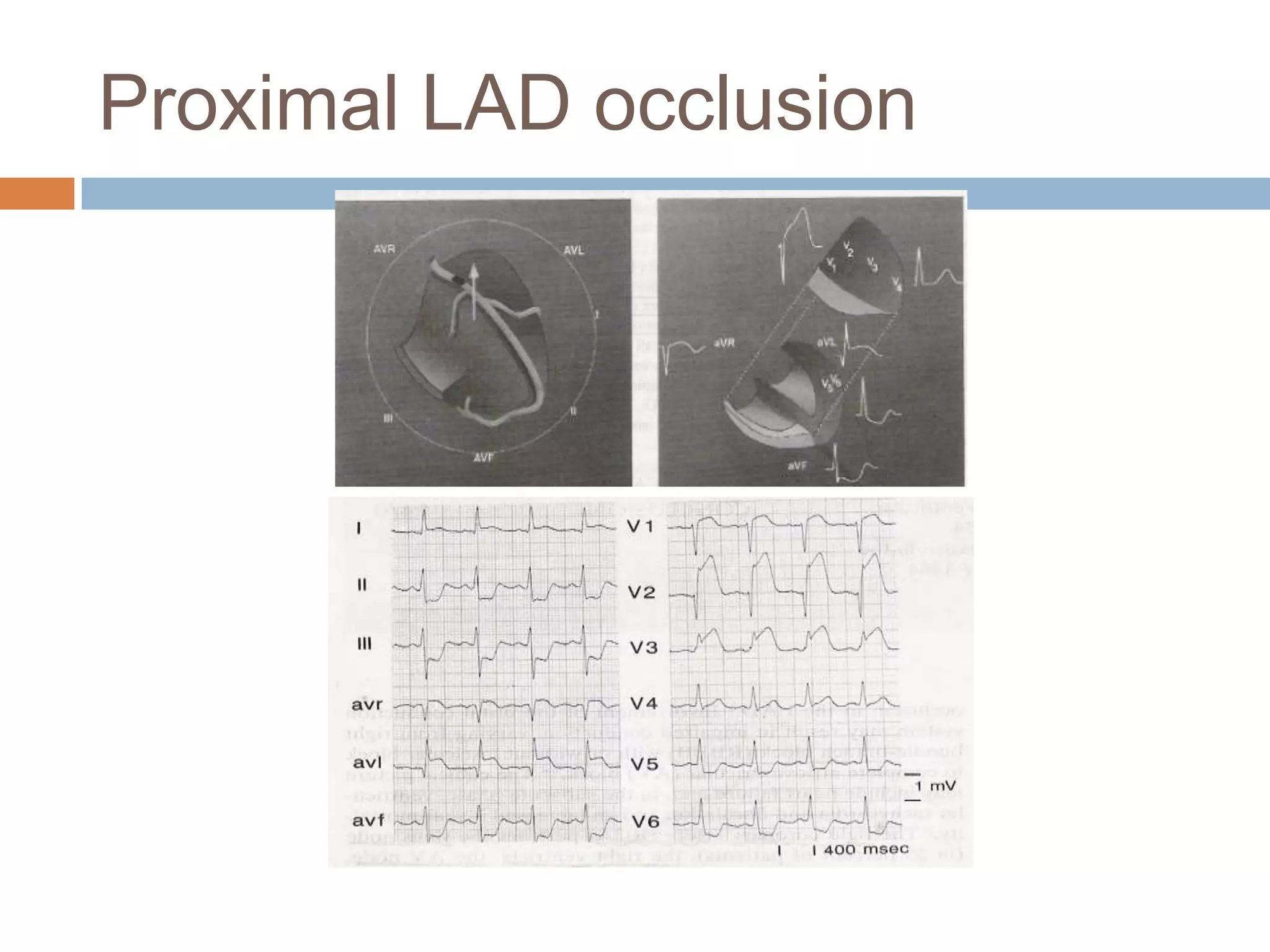 Proximal LAD occlusion
 