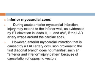 ECG LOCALISATION OF CULPRIT ARTERY IN STEMI | PPTX