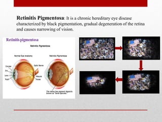 ARTIFICIAL RETINA/EYE (ASR,BIONIC EYE) | PPTX