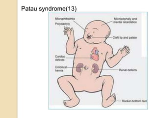Patau syndrome(13)
 