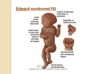 Edward syndrome(18)
 