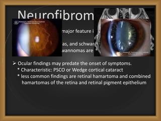 Neurofibromatoses 2
 CNS tumors are the major feature in NF2.
 Meningiomas, gliomas, and schwannomas are common, but
bilateral vestibular schwannomas are nearly always present.
 Ocular findings may predate the onset of symptoms.
* Characteristic: PSCO or Wedge cortical cataract
* less common findings are retinal hamartoma and combined
hamartomas of the retina and retinal pigment epithelium
 