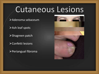 Cutaneous Lesions
Adenoma sebaceum
Ash leaf spots
Shagreen patch
Confetti lesions
Periangual fibroma
 