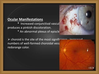 Ocular Manifestations
* Increased conjunctival vascularity commonly
produces a pinkish discoloration.
* An abnormal plexus of episcleral vessels.
 choroid is the site of the most significance - increased
numbers of well-formed choroidal vessels - bright red or
redorange color.
 